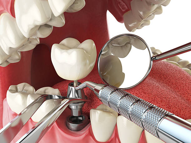 Best Emergency Treatment for Dental Infections or Abscesses in North East, MD